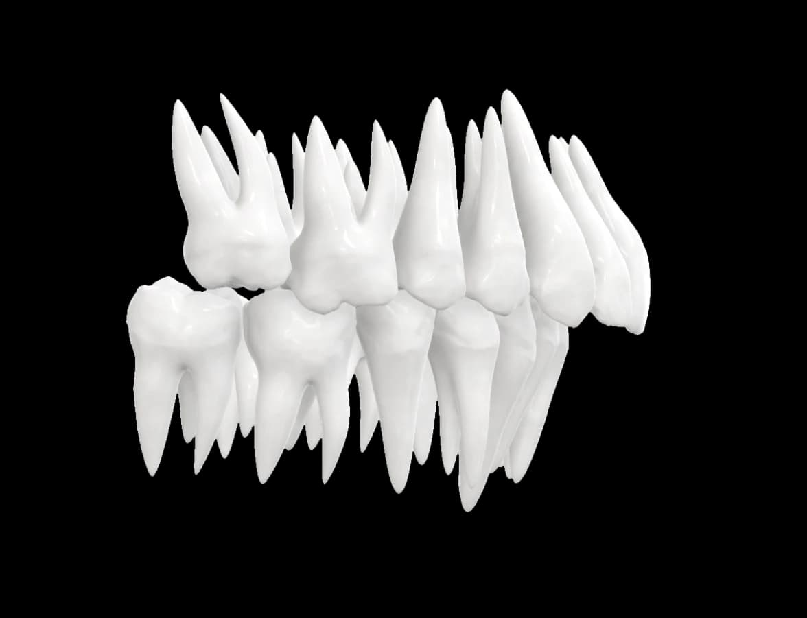 Overbite