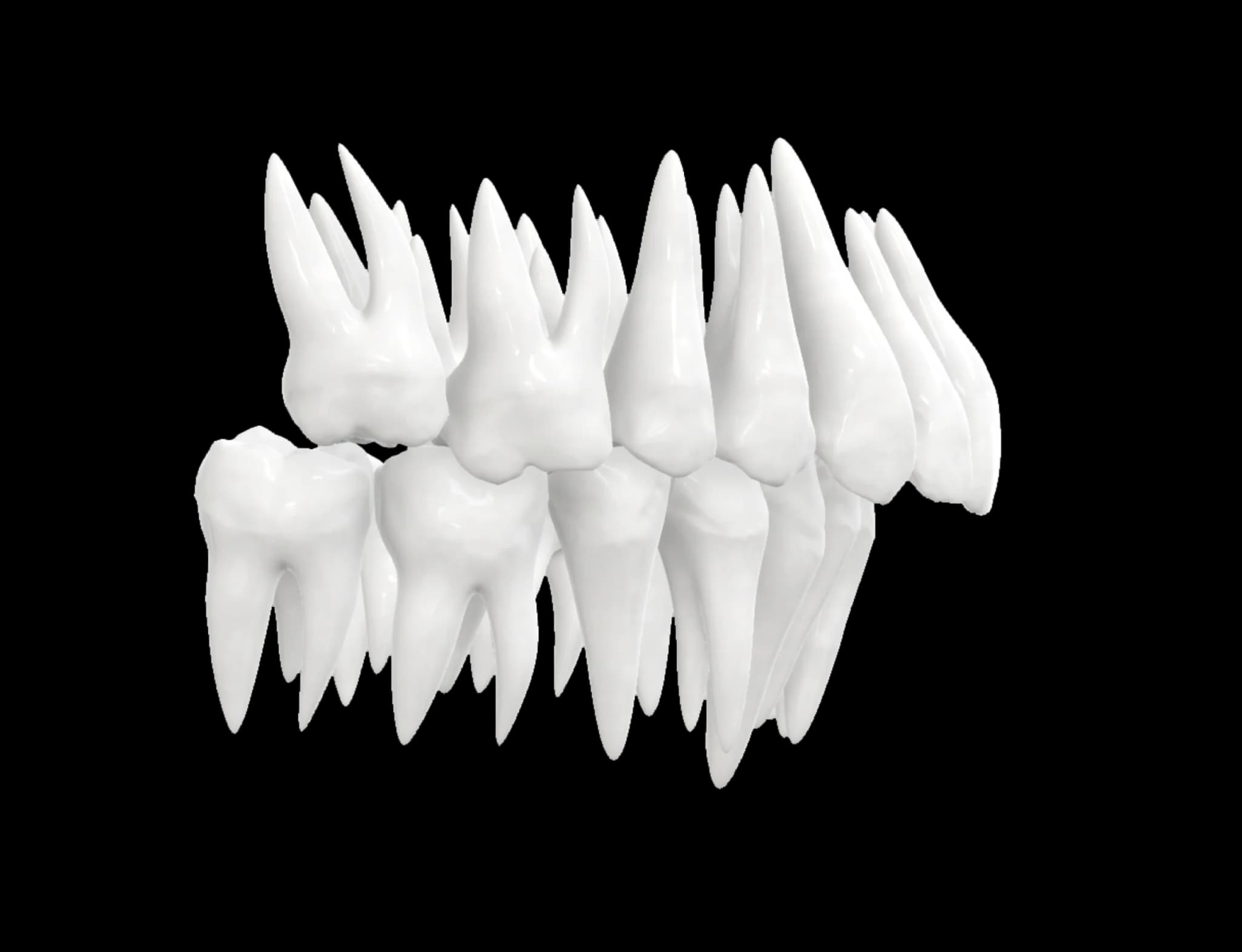 Overbite