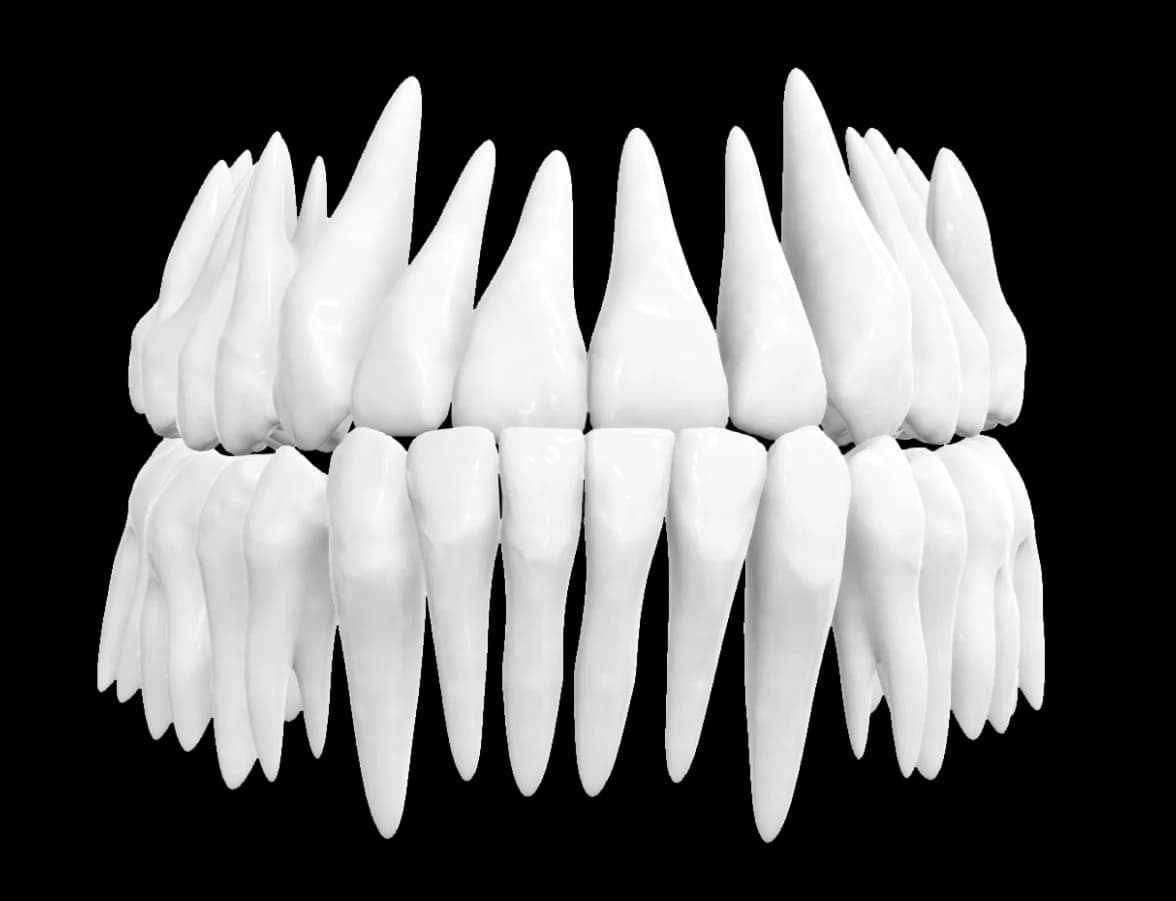 Underbite