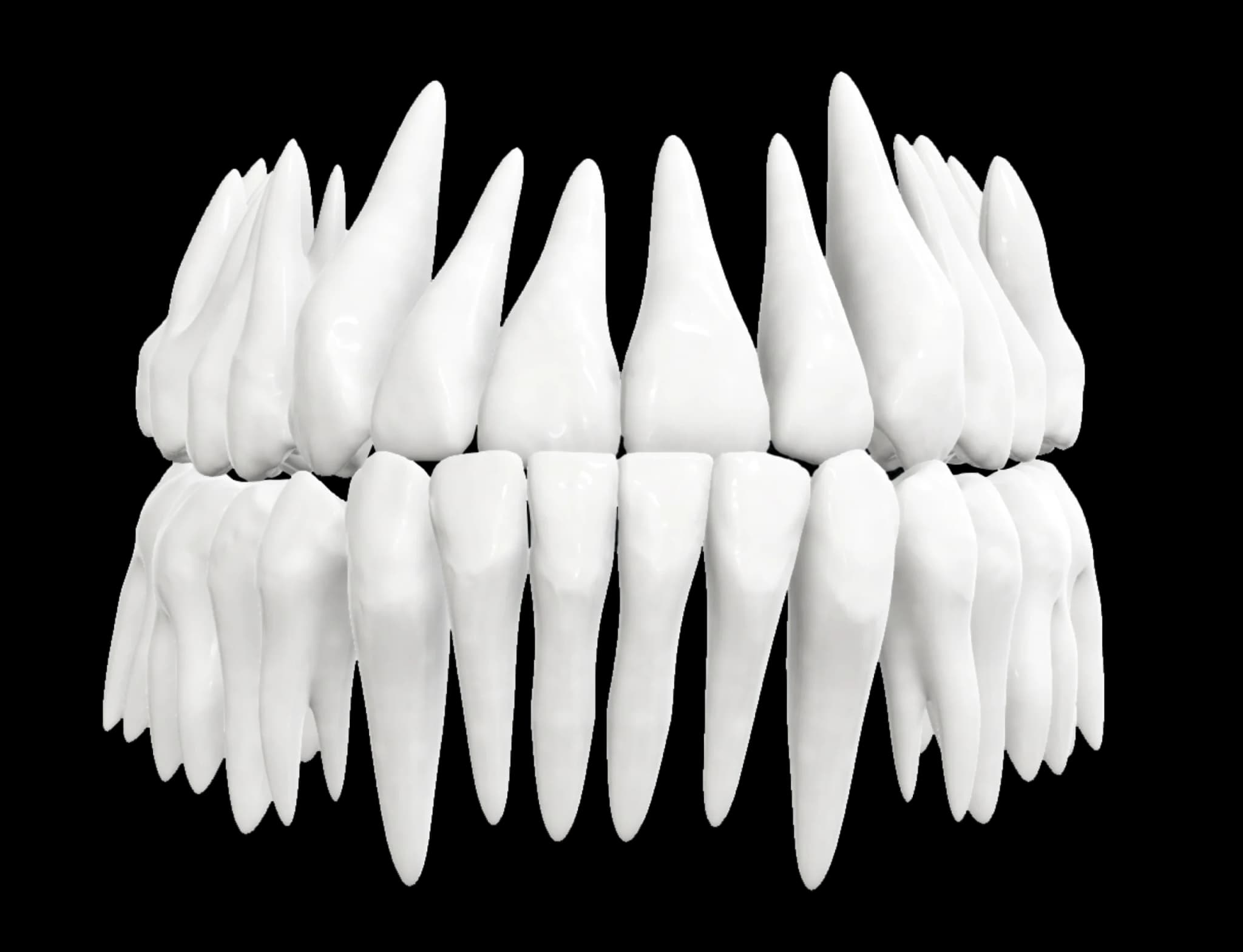 Underbite